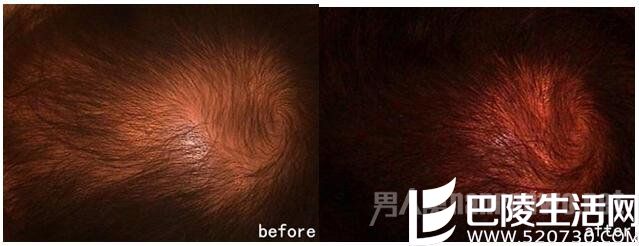 毛发移植前后对比照