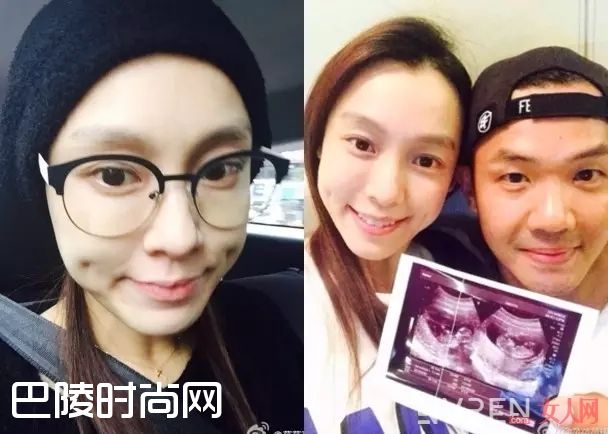 产后内分泌导致发际线高_发际线太高太丑怎么办？戳进来我教你