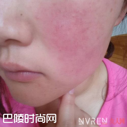 红血丝产生的原因_面部红血丝能彻底治好吗 找对方法带给你完美蜕变