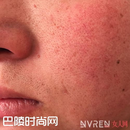 如何治愈红血丝_面部红血丝能彻底治好吗 找对方法带给你完美蜕变