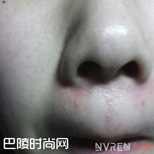 红血丝产生的原因_面部红血丝能彻底治好吗 找对方法带给你完美蜕变