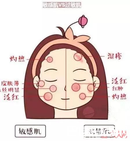 如何自测敏感肌_敏感肌换季如何保养？一次搞定所有问题