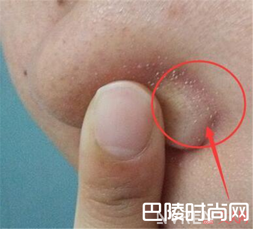 鼻子边挤出白色小颗粒是什么_鼻子边挤出来白色的小颗粒居然是黑头？那就把它扼杀了