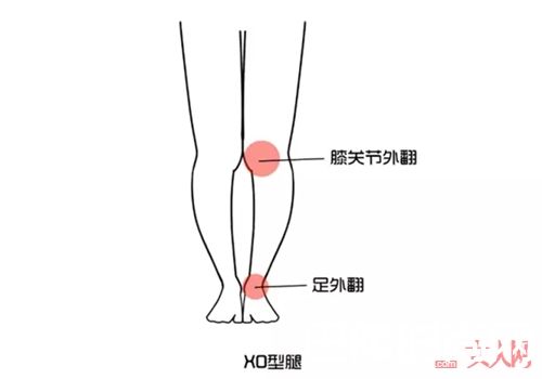 XO形腿如何选择裙子?_又到了露腿的季节 你知道如何根据腿型选裙子吗?