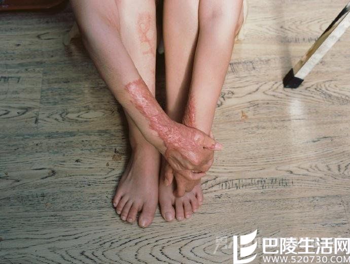 周岩腿部伤疤写真