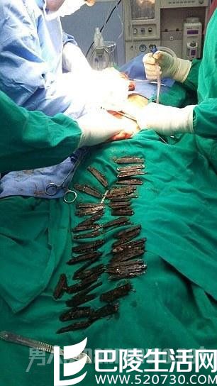 医生帮其开到取刀片