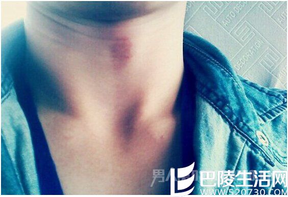 男孩被女友留吻痕丧命 