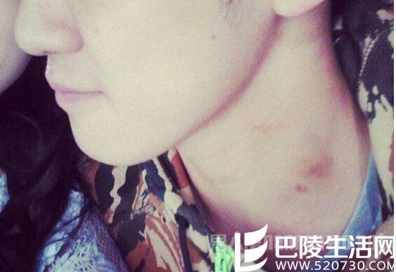 脖子留吻痕