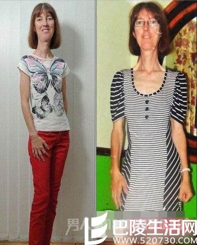 肌肉纤维失调 肌肉纤维失调