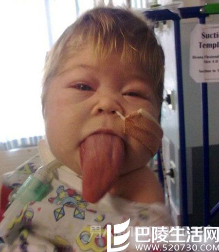 舌头不停生长的孩子 舌头不停生长的孩子