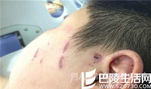 男童脸上的伤