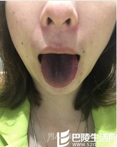 女子吃火锅舌头变黑 女子吃火锅舌头变黑