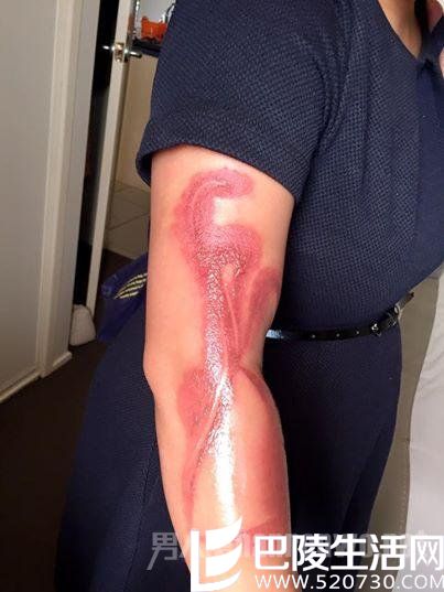 澳孕妇睡觉被灼伤