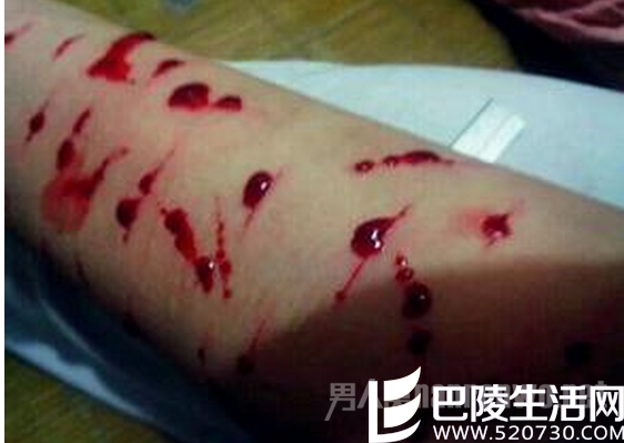持刀自残砍手臂