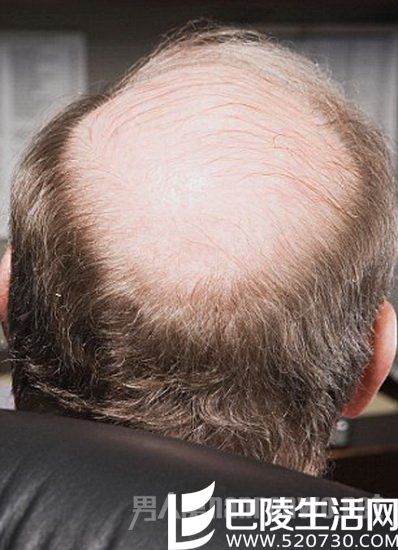 植发失败修复