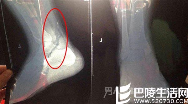 抖腿致左脚骨折