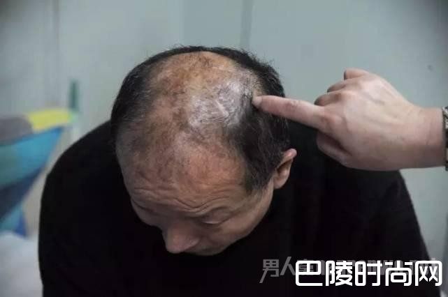 李建利颅部被修复的部分 李建利颅部被修复的部分