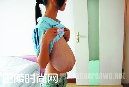 女童患上巨乳症