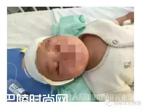 男童摔倒筷子插入脑袋