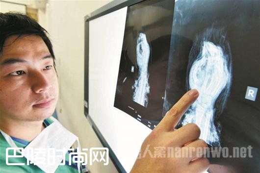 兄弟被鞭炮炸伤案例