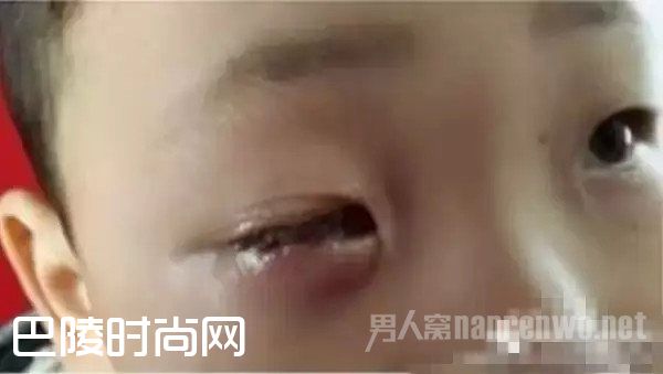 5岁男童玩干燥剂被炸伤