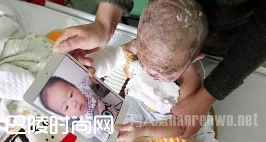 一锅热汤倒扣在1岁宝宝的头上