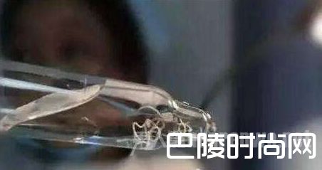老太眼中取出的虫