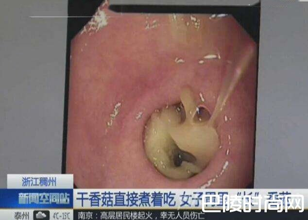 胃镜检查 胃镜检查