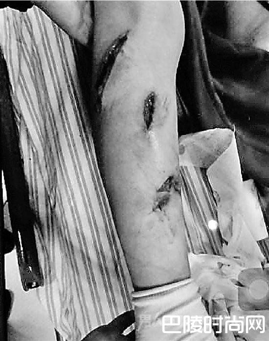 小腿被打皮开肉绽 小腿被打皮开肉绽