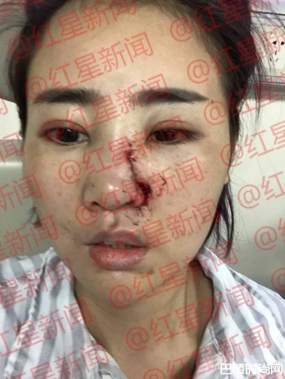 丽江被打毁容女孩公开近照