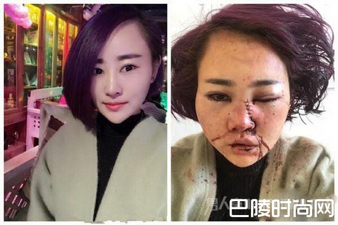 丽江被打毁容女孩公开近照