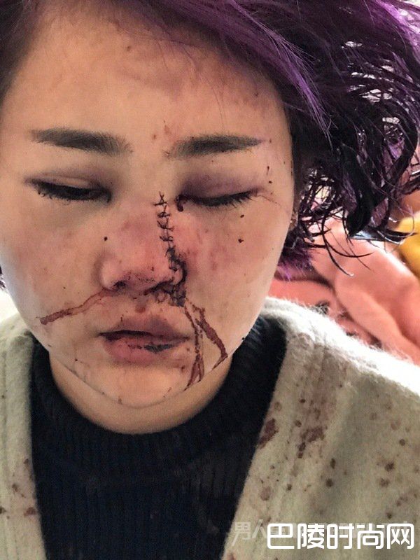 被打毁容女孩