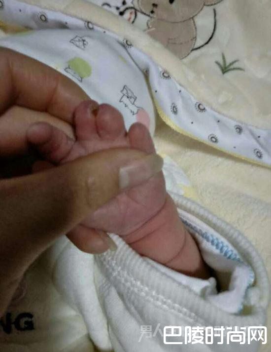 伍先生女儿的手指也有发育不全的情况 伍先生女儿的手指也有发育不全的情况