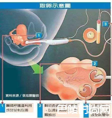 取卵示意图