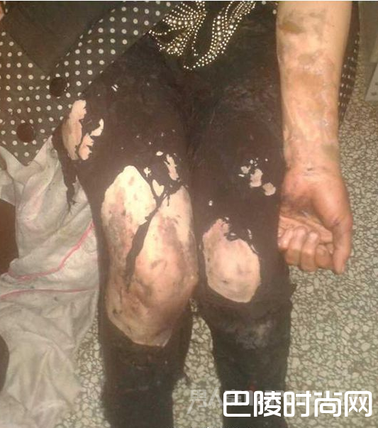 被泼硫酸 被泼硫酸