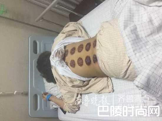 拔罐理疗 拔罐理疗