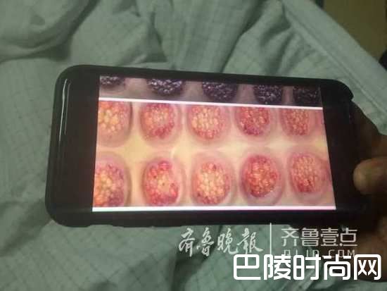 过度拔罐 过度拔罐