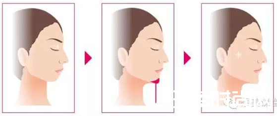 假体填充丰下巴