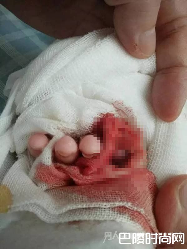 小指已经残缺 小指已经残缺