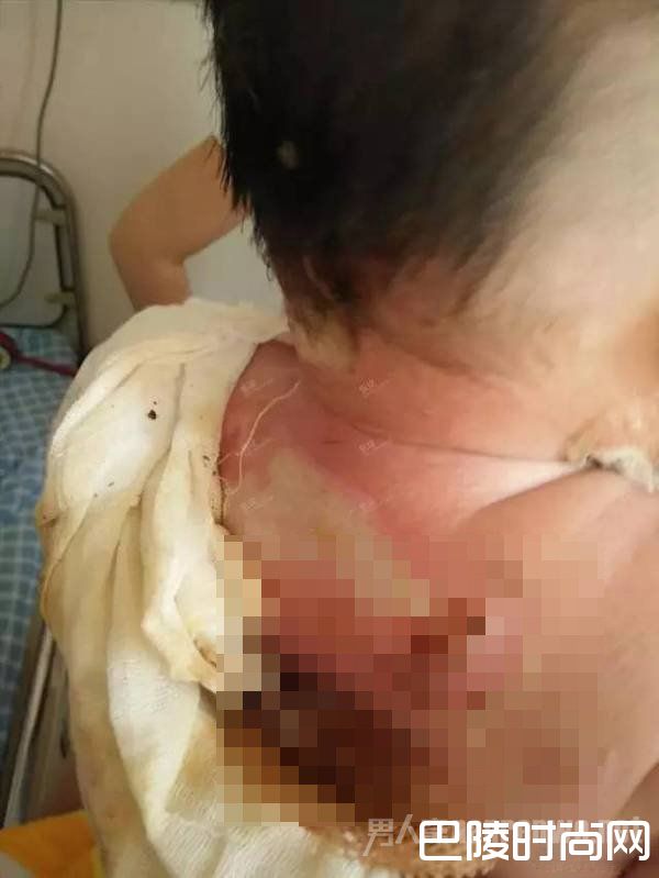 孩子被烫的伤口 孩子被烫的伤口