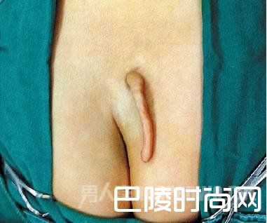 “切尾”手术 “切尾”手术