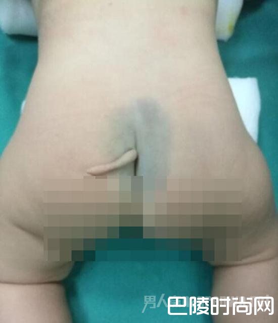 女婴屁股后长尾巴 女婴屁股后长尾巴