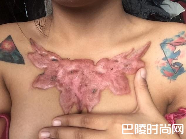 女学生除纹身被坑留疤痕