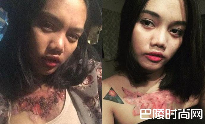 女学生除纹身被坑留疤痕