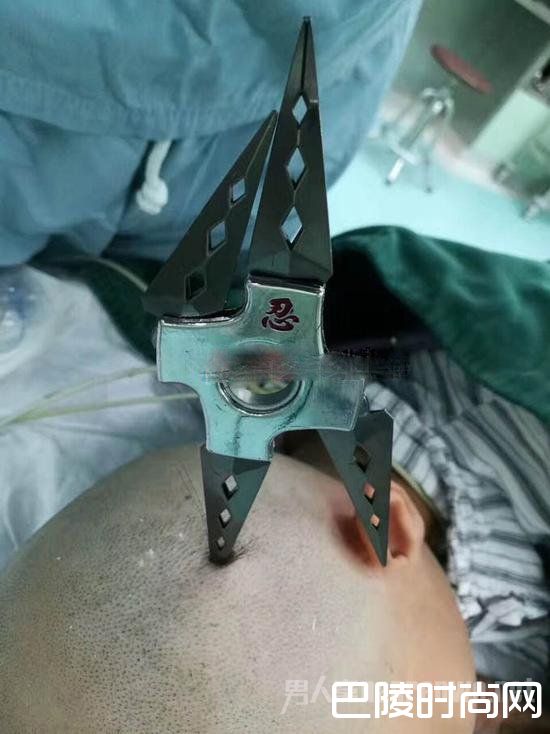 飞镖插入女孩头颅 飞镖插入女孩头颅