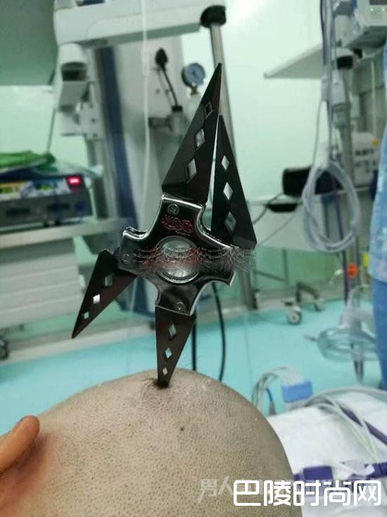 飞镖插入女孩头颅 飞镖插入女孩头颅