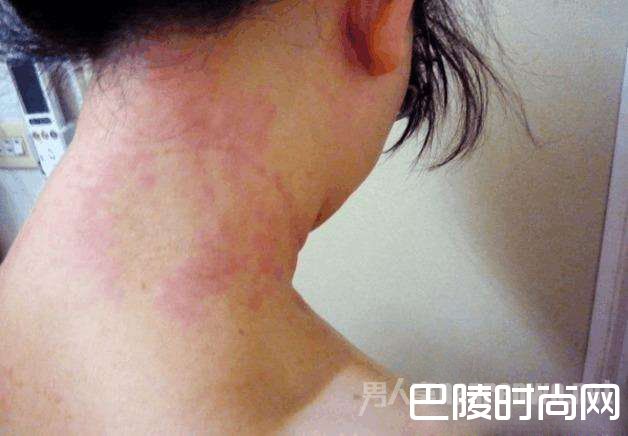 被男友吻过的地方全过敏