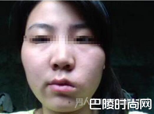 电扇吹脸一夜面瘫