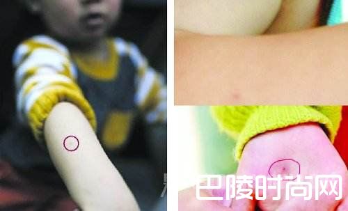 针扎儿童