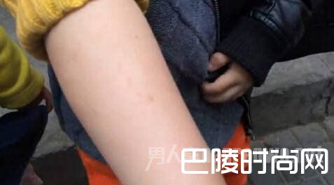 针扎儿童 针扎儿童